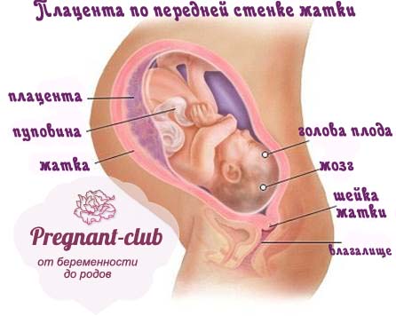 Схема расположения плаценты по передней стенке матки
