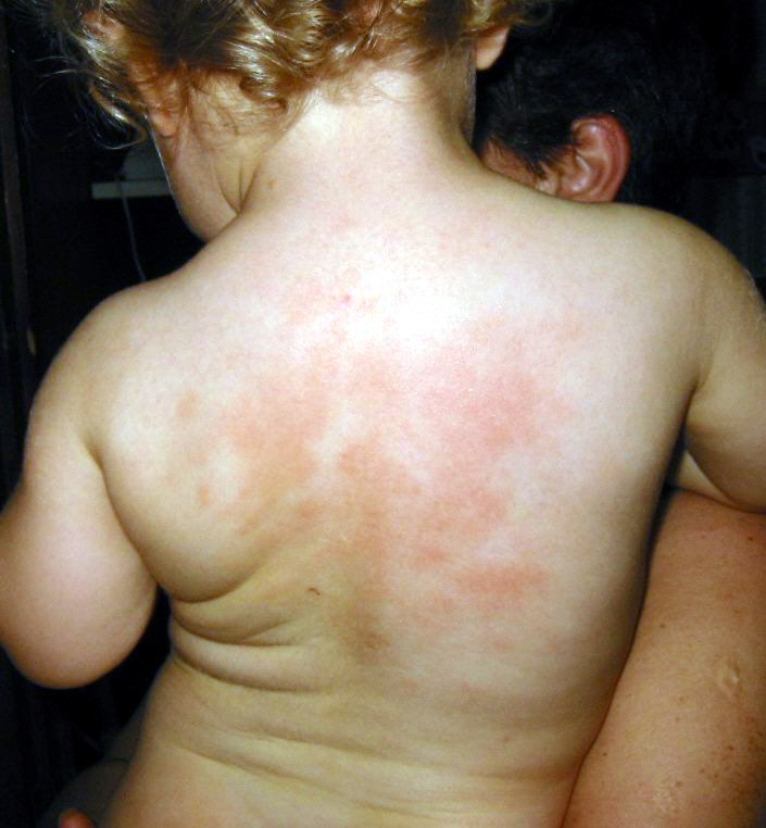 Потничка на спине ребенка - фото